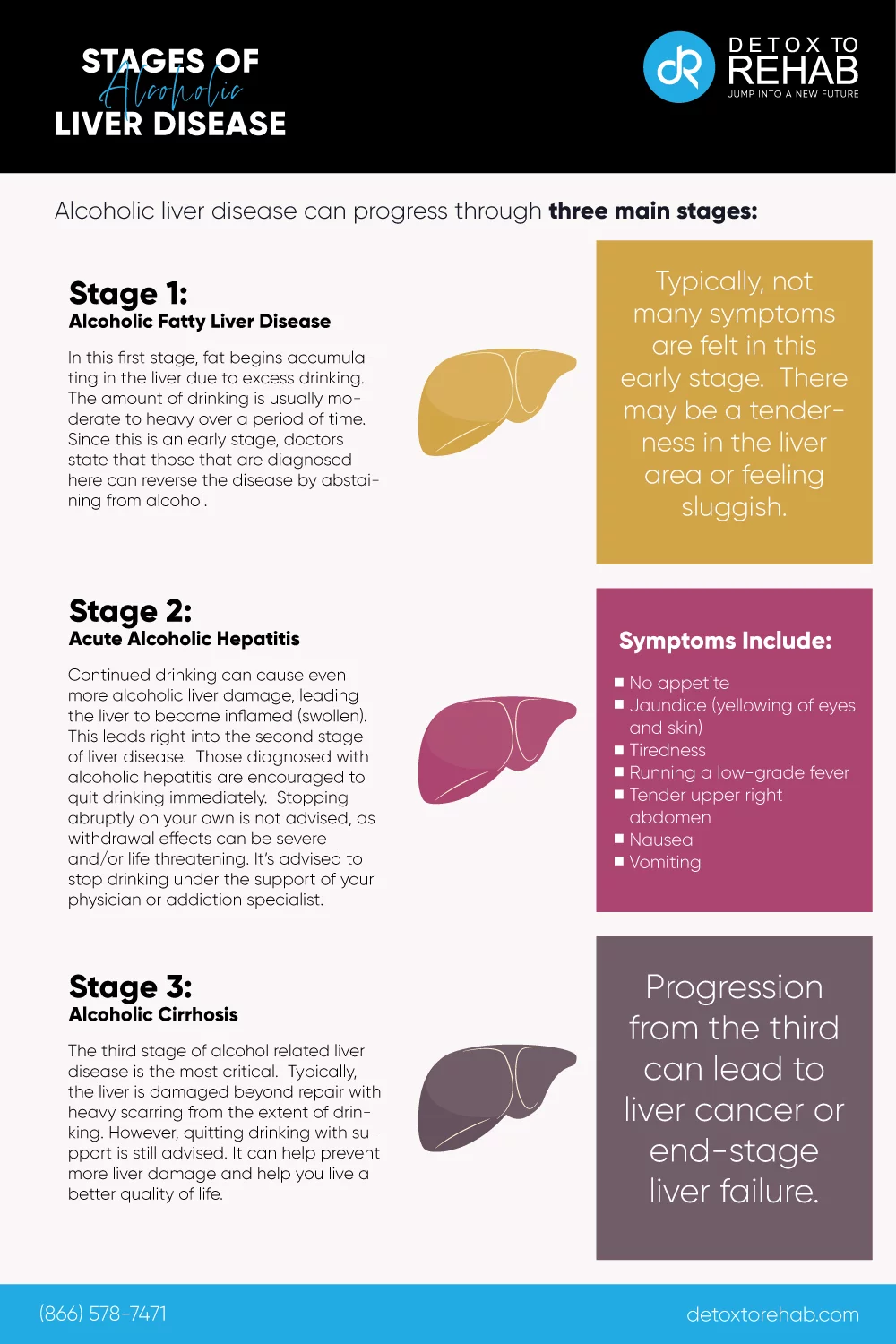 stages of alcoholic liver disease infographic
